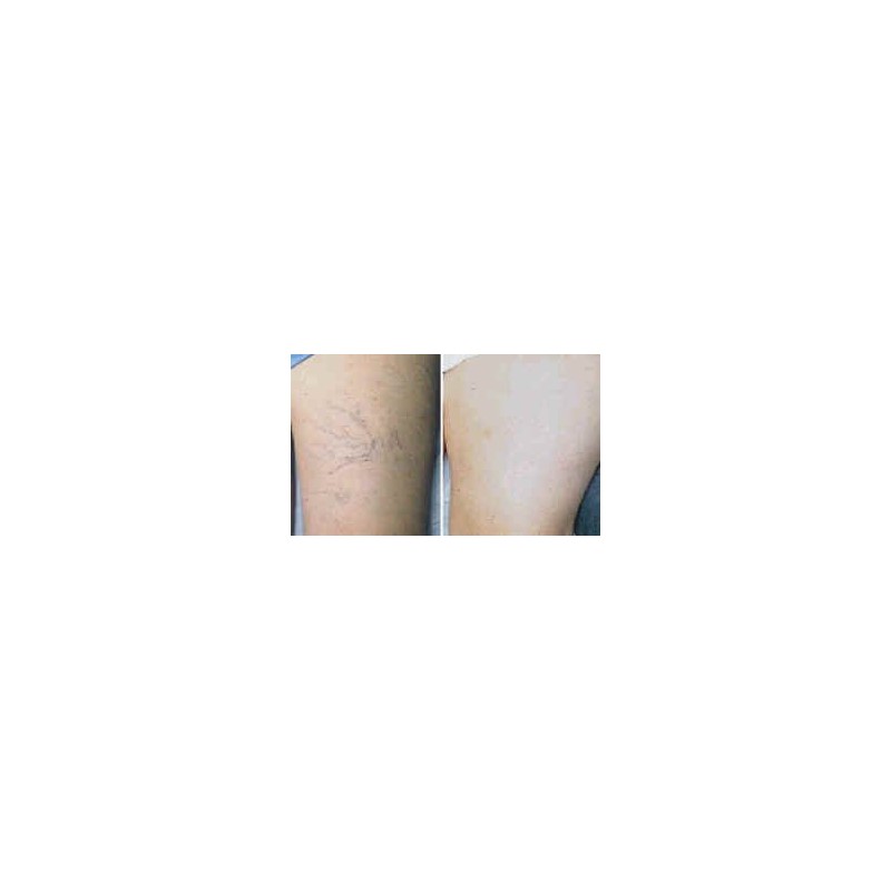 K MAX- Maximim Strength Vitamin K 5 Cream for Stretch