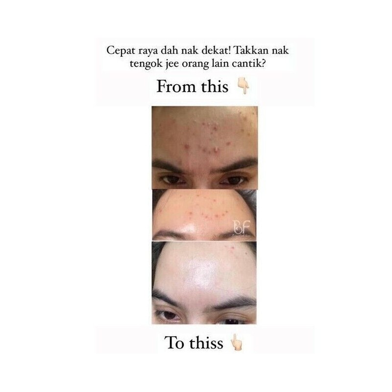 Tabita Original Tabita Skincare Skin Anti-Aging Acne Scar Stretch Mark
