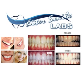 Professional Custom Teeth Whitening Tray Kit. Dental Lab Direct, Custom Made Teeth Whitening Tray, U.S.A Made Bleaching Trays with 38% High Intensity Gel Fast Results Custom Upper and Lower Trays