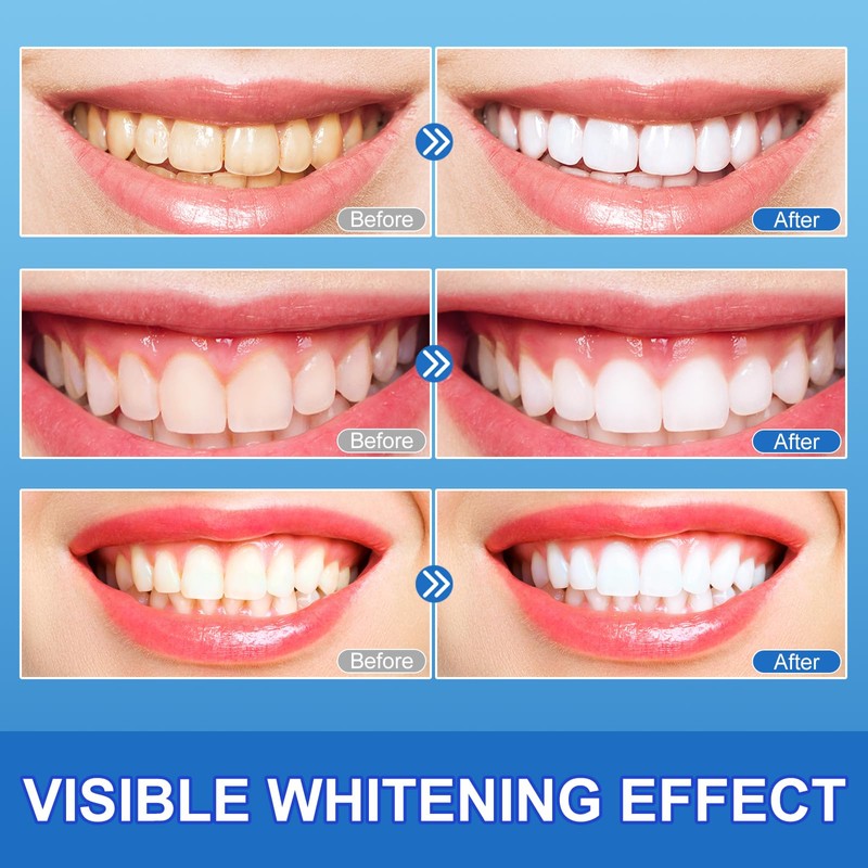 9D Teeth Whitening Strips 14 Treatments, Enamel Safe, Whitening Teeth