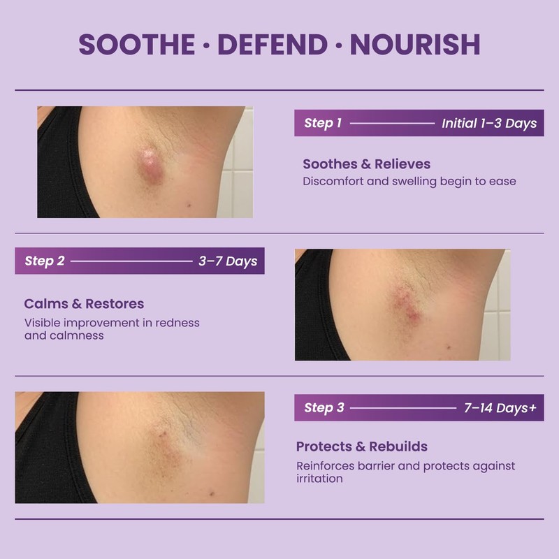Easment Hidradenitis Suppurativa Flare Defense Balm: 2oz Science-Backed Daily Protection