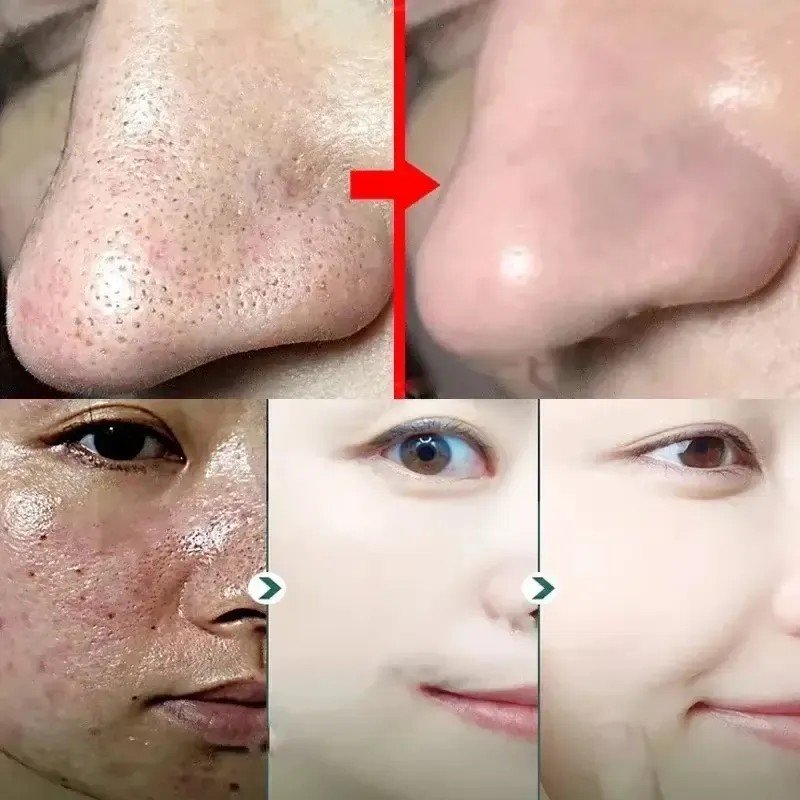 Mascarilla Sólida Limpia Poros Antiespinillas Control Grasa