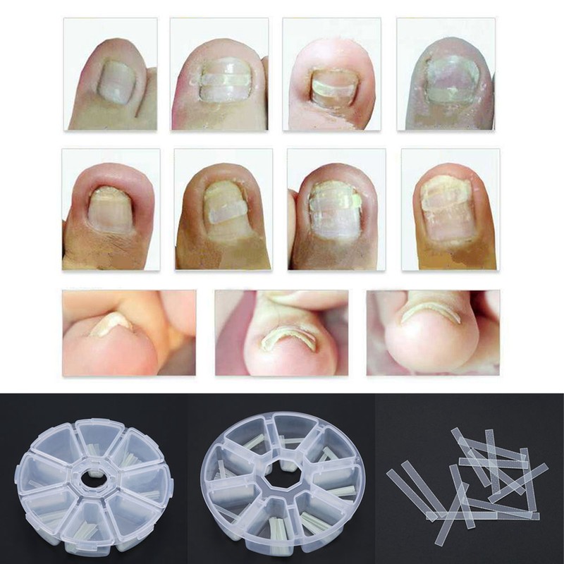 120pcs/box Ingrown Pedicure Toenail Straightening Clip Toe Nail Sticker Patch