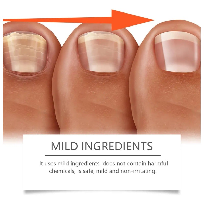 Tratamiento De Uñas De Los Pies Para Mujeres, Extractos De