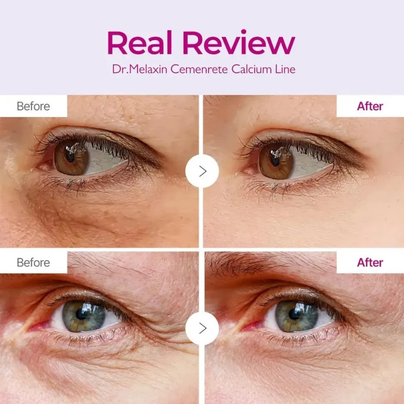 J/ Sdfs Parche Ocular Cemenrete Calcium Volume Eye Fgsfs
