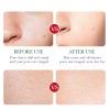 Veraly Liquido Antiacne Serum Reparador Espinillas Acido Salicilico
