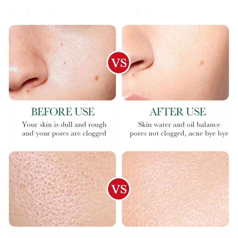 Veraly Liquido Antiacne Serum Reparador Espinillas Acido Salicilico