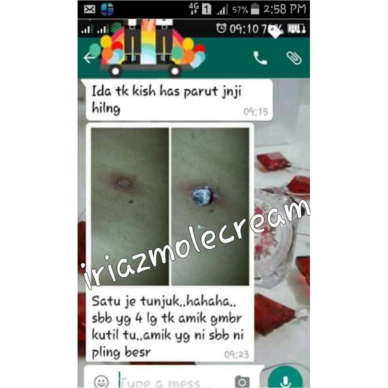 IRIAZ MOLE CREAM BUANG TAHI LALAT KUTIL BIJI KOLESTEROL