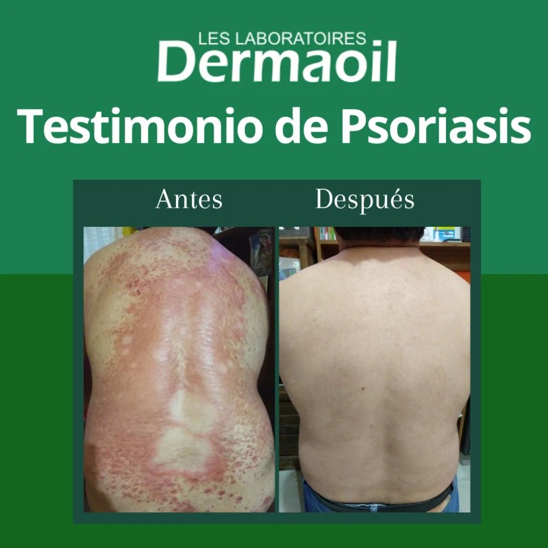 Pomada Natural Para Psoriasis: Hidratación Profunda.