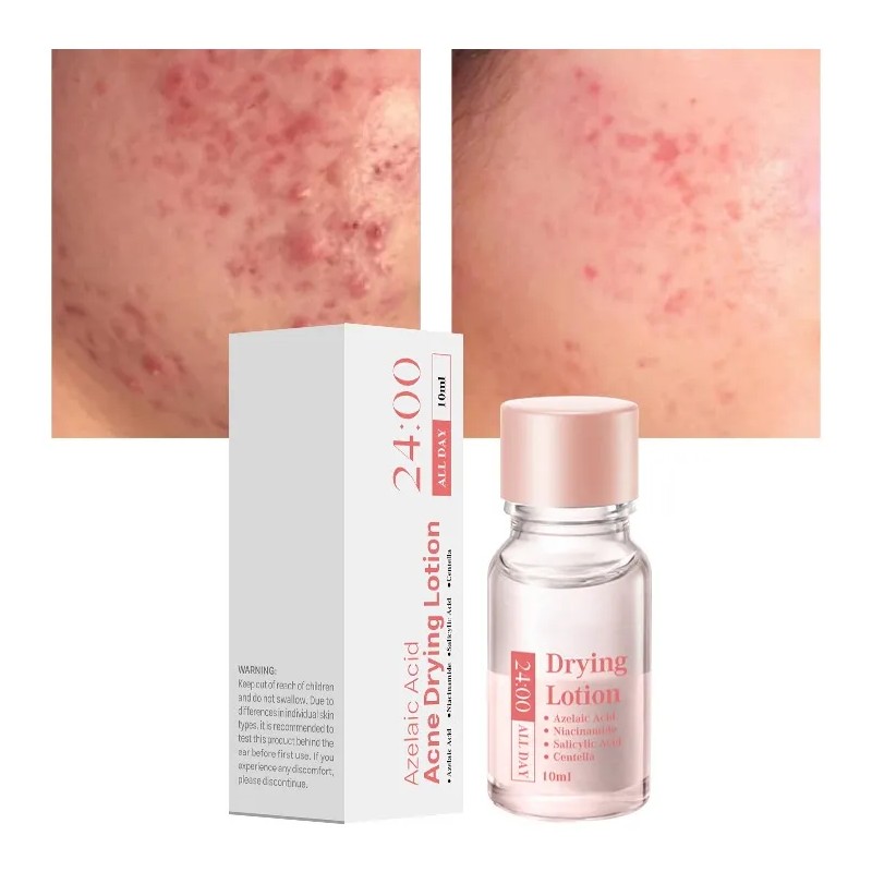 Acne Buster Loción Secante Con Ácido Salicílico 2pcs Todo Tipo