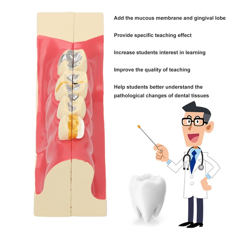 Right Lower Posterior Tooth Model 2X Magnification Detachable Resin Tooth