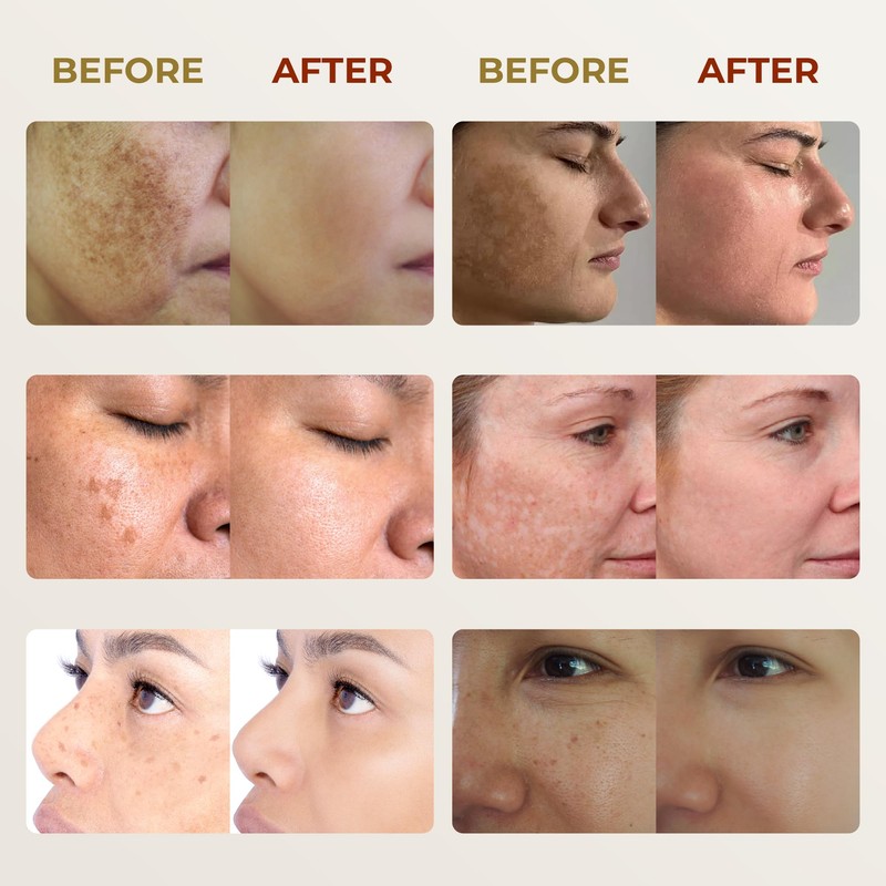 ABERA Melasma Cream (Premium Version) - Cream for Face Treatment,