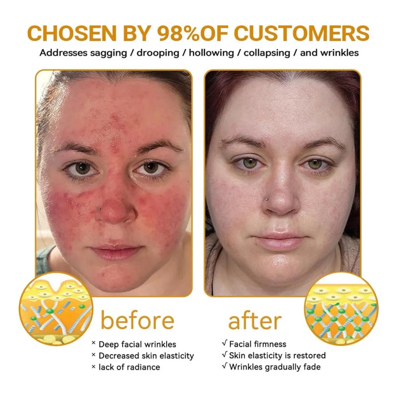 Mzhl Crema Awzlove For Reducir Las Imperfecciones De La