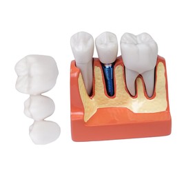 Sarini Oral Tooth Model Dental Implant Model With Removable Crown And Bridge Suitable For Classroom Demonstration And Dental Student Training, Education