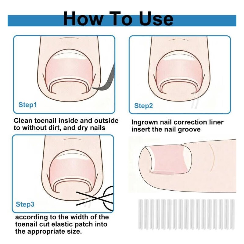 (30+2) Pack Ingrown Toenail Correction Treatment Kit, 30PCS Ingrown Toenails