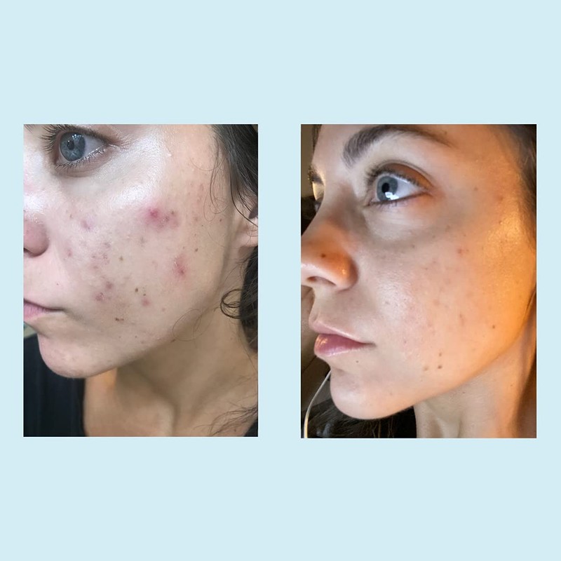 Glycolic Acid 30% Gel Peel - Enhanced with Retinol and