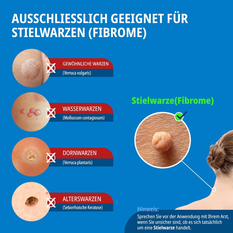 Evolsin anti-stem wart