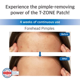 Labottach 4 T-zone Acne Pimple Treatment Patches for Face Body Treatment a Large Forehead Zits Sticker With Zinc, Spot Stickers for Face and Skin, Olive Leaf Extract, Tea Tree, Up To 8 Hours