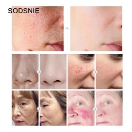 ✨ Sérum Intensivo para Piel Acneica: Reduce Enrojecimiento 🔴, Poros 👃 y Exceso de Grasa 💧