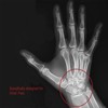 Comfort Cool D-Ring Wrist Brace. Indications - Carpal Tunnel, Tendonitis,