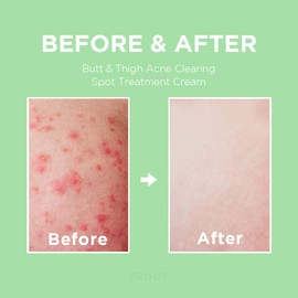 Butt Acne Treatment Cream in Tube Type | Travel Friendly | Clears Acne, Ingrown Hairs, Zits, Razor Bumps, Blackheads and Dark Spots for the Butt, Thigh and Other Sensitive Area | Prevents Future Breakouts