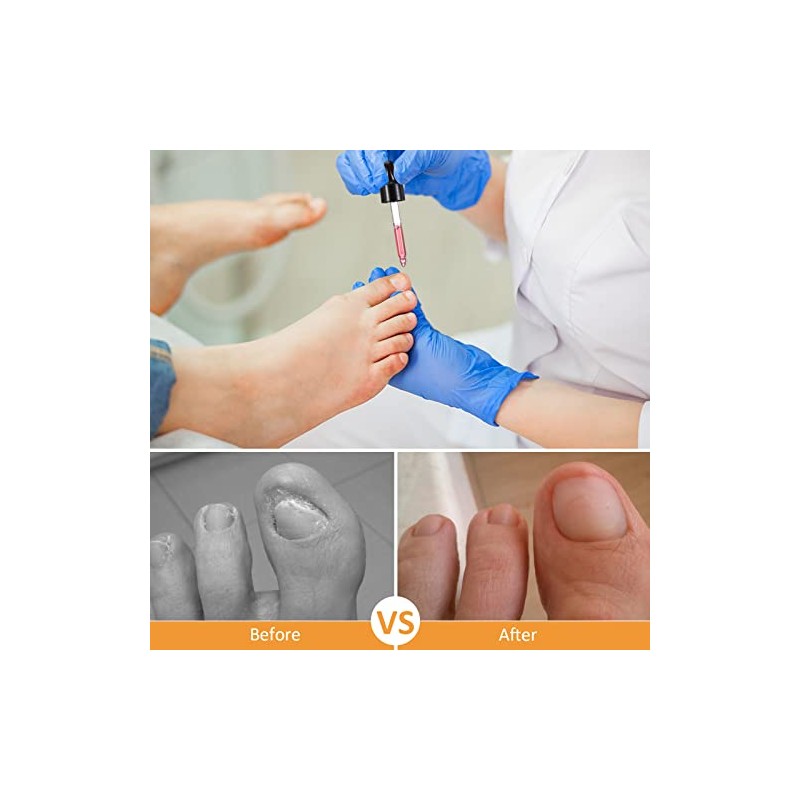 Treatonic Tratamiento de uñas encarnadas – Kit de alivio del