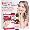 Aichun Beauty Scar Removal Serum Pimples Stretch Marks Face Whitening