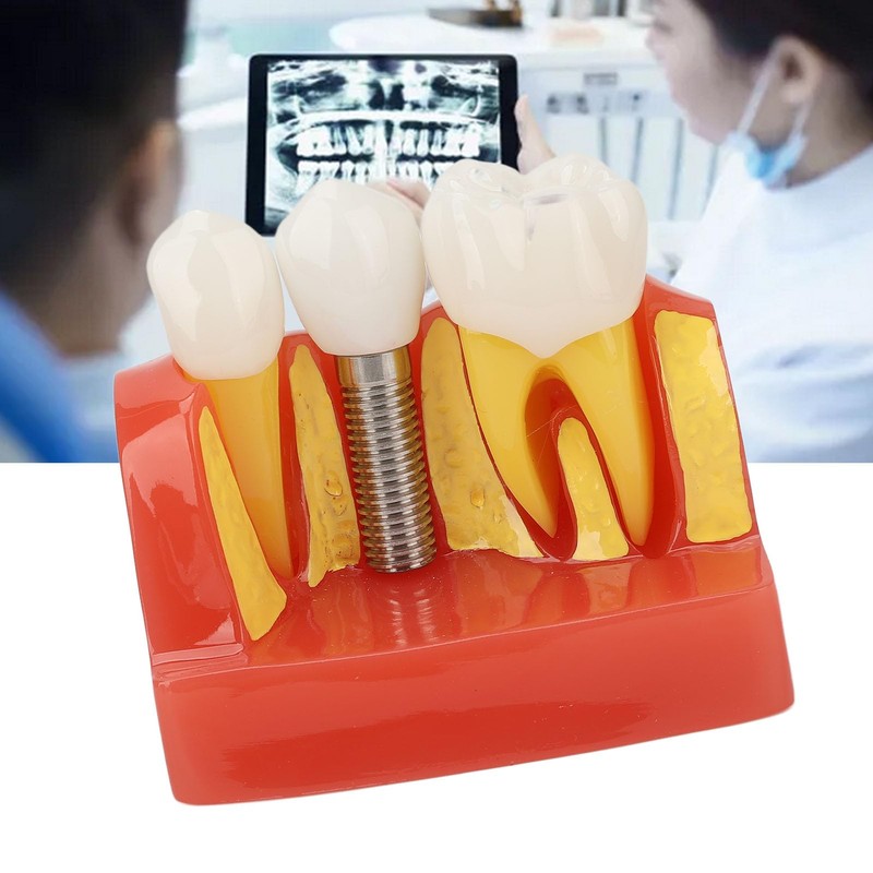 Dental Implant Teeth Model, Dental Implant Analysis Crown Bridge Model,