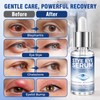 Blepharitis Treatment Serum 30ml, Natural Stye Eye Treatment with Hyaluronic