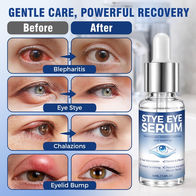 Blepharitis Treatment Serum 30ml, Natural Stye Eye Treatment with Hyaluronic