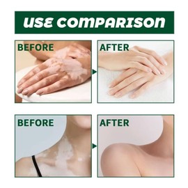 Treatment Cream,Freckle Removal Cream,Freckle Remover,Skin Barrier Repair Cr-Eam,Effectively Alleviate The White Blemishes On The Skin,Daily Repair Balm,Deep Moisturizing For Dry Face And Body