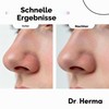 Dr. Herma 2-Step Nose Plasters Against Blackheads - Hydrocolloid Acne