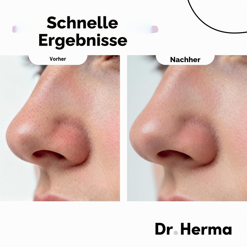 Dr. Herma 2-Step Nose Plasters Against Blackheads - Hydrocolloid Acne