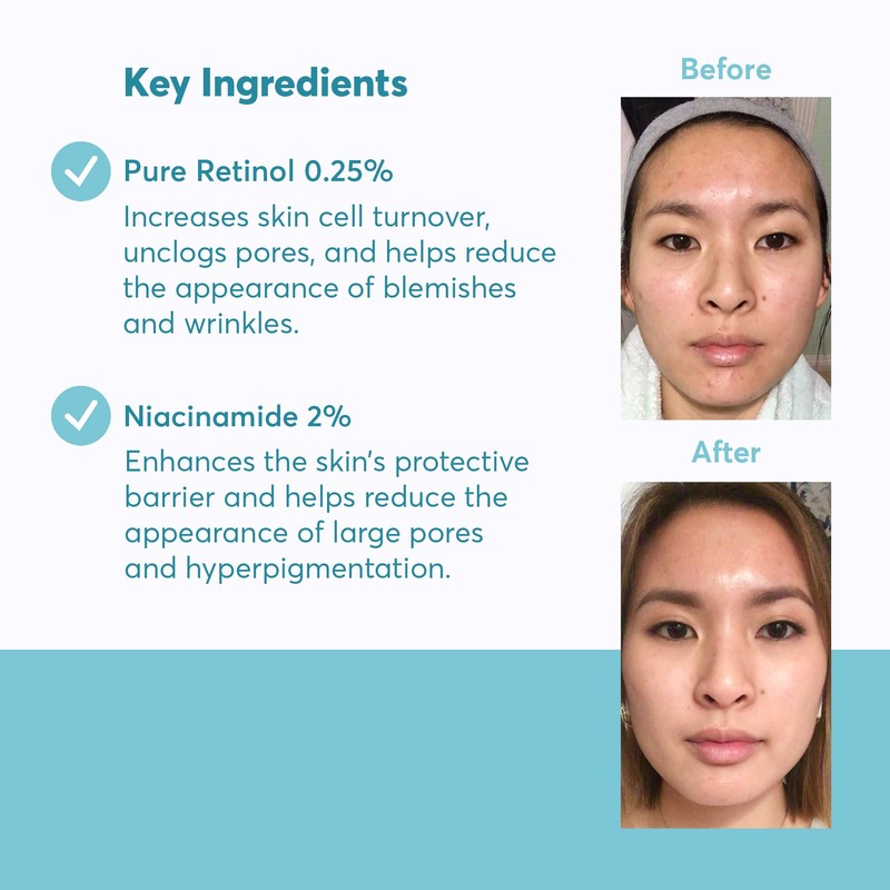 MDacne – Retinol 0.25% and Niacinamide 2% Cream, Reduces Blemishes