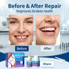 Avvchuy Filling Kit for Teeth, Temporary Chipped Tooth Repair Kit