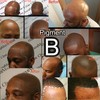 B - Scalp micropigmentation pigments by DermMicro (B)