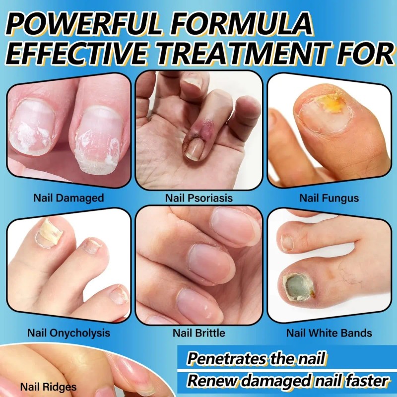 Tratamiento De Hongos En Las Uñas De Los Pies Extra