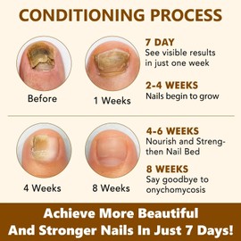 Wormeer Ginger Nail Fungus Conditioning for Toenail - 7-Day Toe Strengthener, Nail Strengthener & Cuticle Conditioning Oil. Essence for Strengthening and Improvement Damaged Fingers and Toes