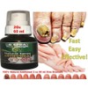 Powerful Extra Strength Anti-Fungal Support for Toenail Fungus and Athlete's Foot - Fungi XS Nail Solution