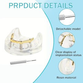 Dental Model Overdenture Transparent Dental Implants Model Detachable Model Lower Jaw Dental Teaching Model Suitable for Education and Study Golden