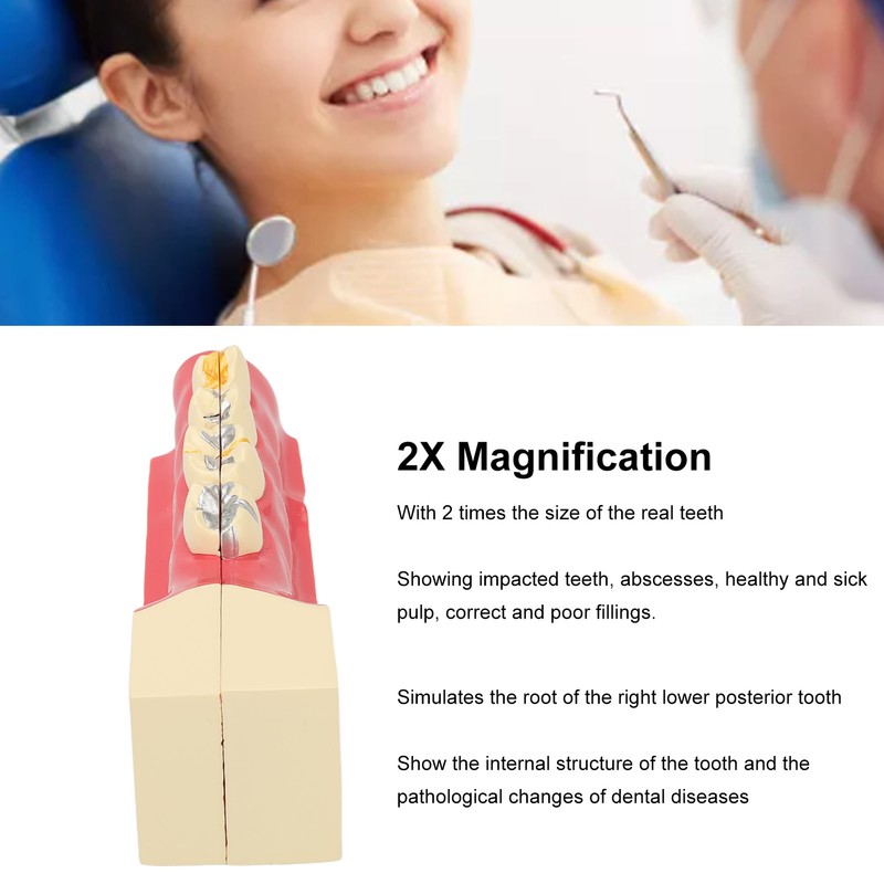 Right Lower Posterior Tooth Model 2X Magnification Detachable Resin Tooth