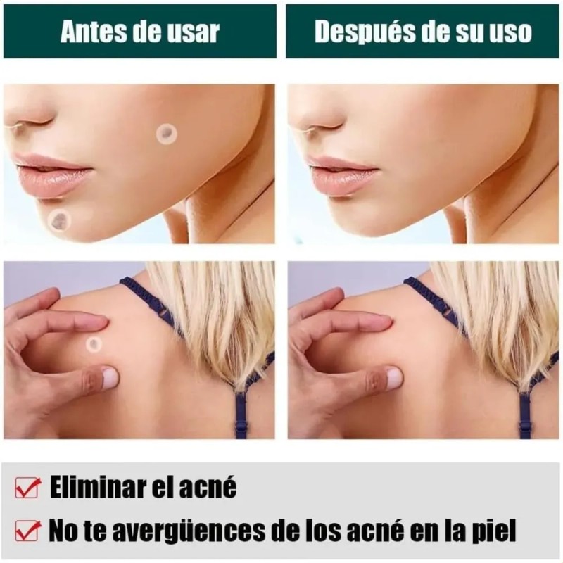 180 Parches Hidrocoloides Ultra Finos For Acné