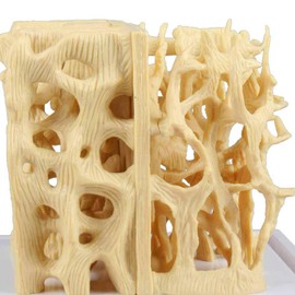 Erler Zimmer Bone Comparison Model Anatomy Model Highly Enlarged Healthy Osteoporotic