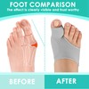 Hallux Valgus Socks, Hallux Valgus Bandage, Hallux Valgus Correction, Bunion