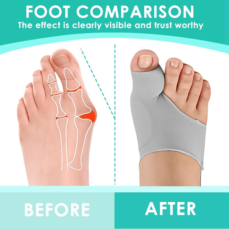 Hallux Valgus Socks, Hallux Valgus Bandage, Hallux Valgus Correction, Bunion