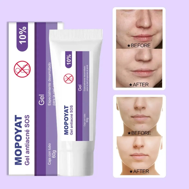 3pcs Gel Peróxido Benzoilo 10% Elimina Acné Puntos Negros