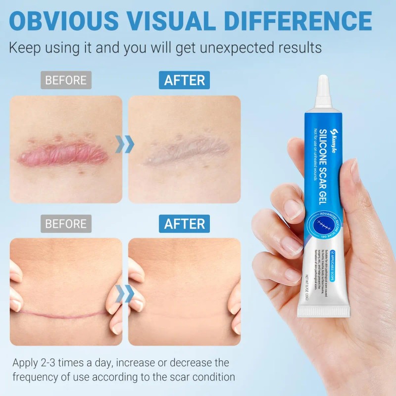 Gel De Silicona Para Cicatrices, Crema Para Cicatrices, Gel
