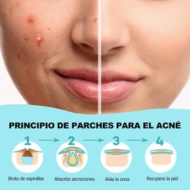 Parches Hidrocoloides para Acné (108 uds) - Ultra Finos e Invisibles, Absorben Impurezas y Sebo, Resistentes al Agua, Uso Diario y Nocturno, Tratamiento para Espinillas y Puntos Negros