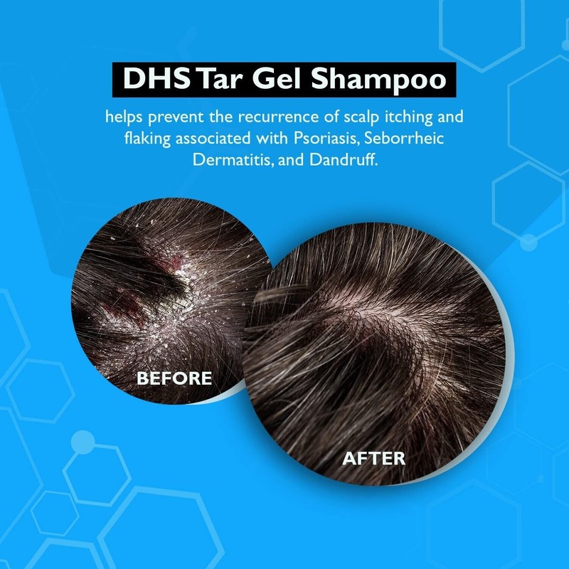 DHS TAR SHAMPOO Anti Dandruff, Psoriasis, Coal Tar GEL 8