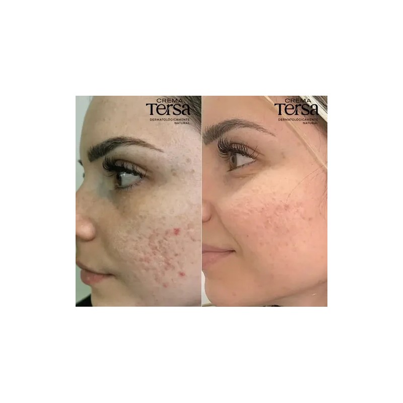 Crema Tersa Despigmentante Quita Manchas Acné Paño De 40g